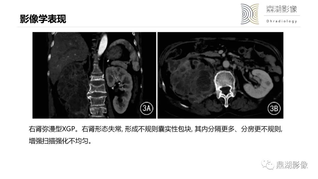 影像PPT - 【PPT】黄色肉芽肿性肾盂肾炎-19 影像PPT - 【PPT】黄色肉芽肿性肾盂肾炎-19