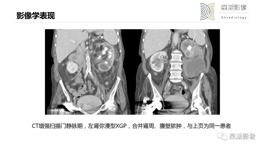 影像PPT - 【PPT】黄色肉芽肿性肾盂肾炎-21 影像PPT - 【PPT】黄色肉芽肿性肾盂肾炎-21