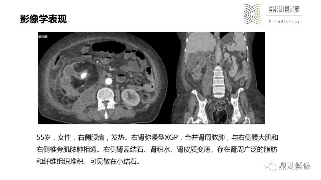 影像PPT - 【PPT】黄色肉芽肿性肾盂肾炎-22 影像PPT - 【PPT】黄色肉芽肿性肾盂肾炎-22