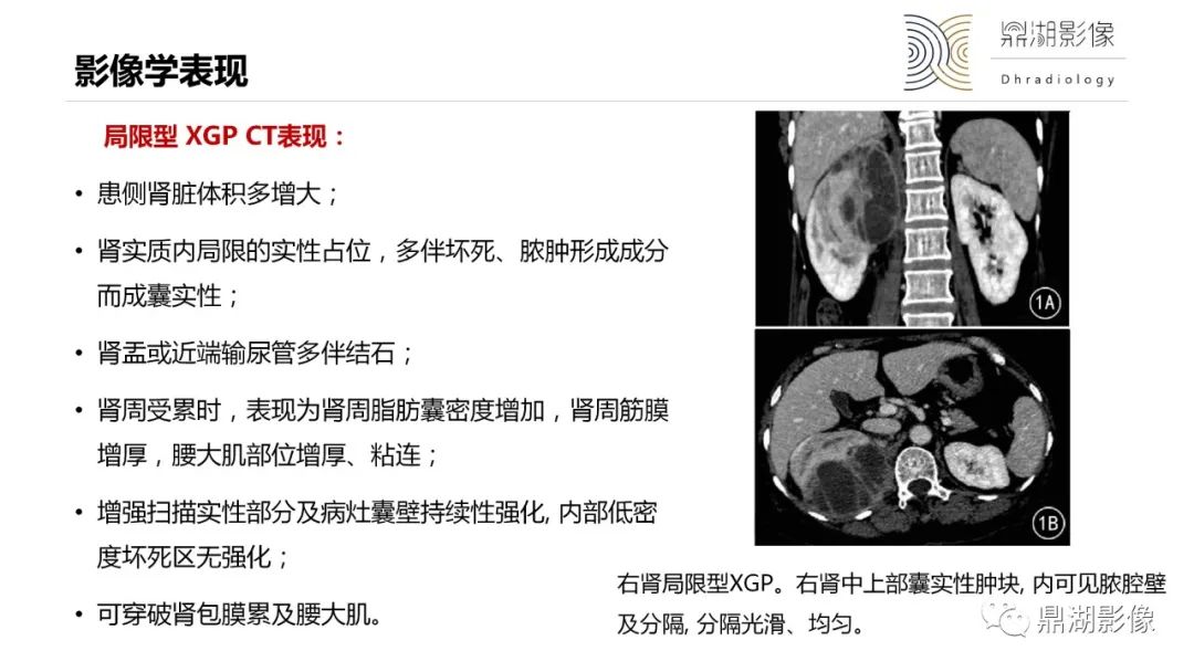 影像PPT - 【PPT】黄色肉芽肿性肾盂肾炎-23 影像PPT - 【PPT】黄色肉芽肿性肾盂肾炎-23