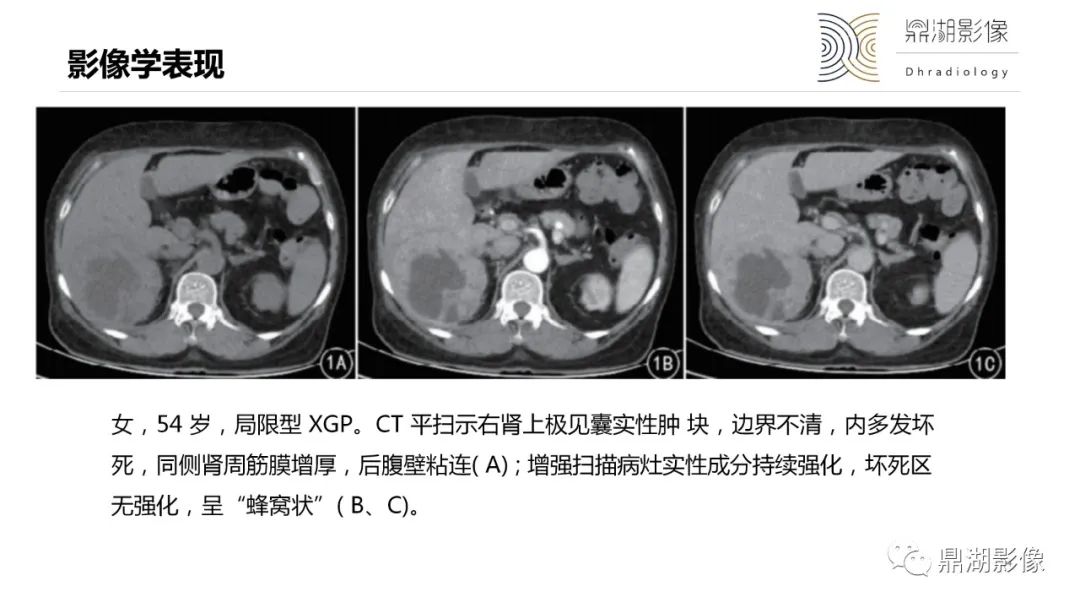 影像PPT - 【PPT】黄色肉芽肿性肾盂肾炎-24 影像PPT - 【PPT】黄色肉芽肿性肾盂肾炎-24