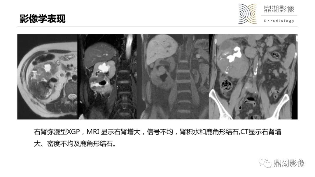 影像PPT - 【PPT】黄色肉芽肿性肾盂肾炎-26 影像PPT - 【PPT】黄色肉芽肿性肾盂肾炎-26