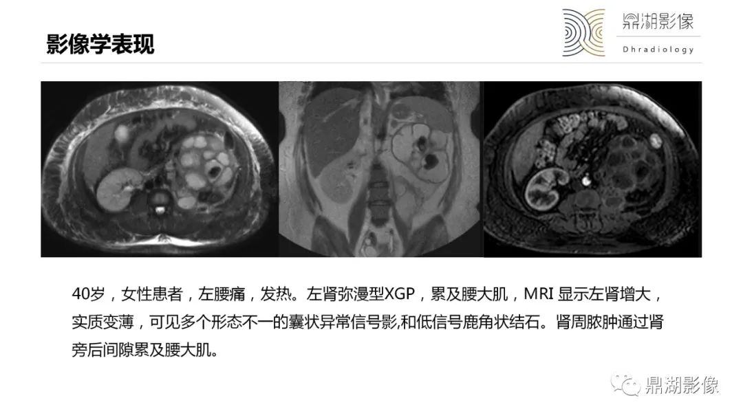 影像PPT - 【PPT】黄色肉芽肿性肾盂肾炎-27 影像PPT - 【PPT】黄色肉芽肿性肾盂肾炎-27