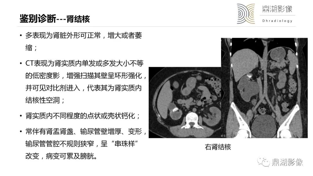 影像PPT - 【PPT】黄色肉芽肿性肾盂肾炎-29 影像PPT - 【PPT】黄色肉芽肿性肾盂肾炎-29
