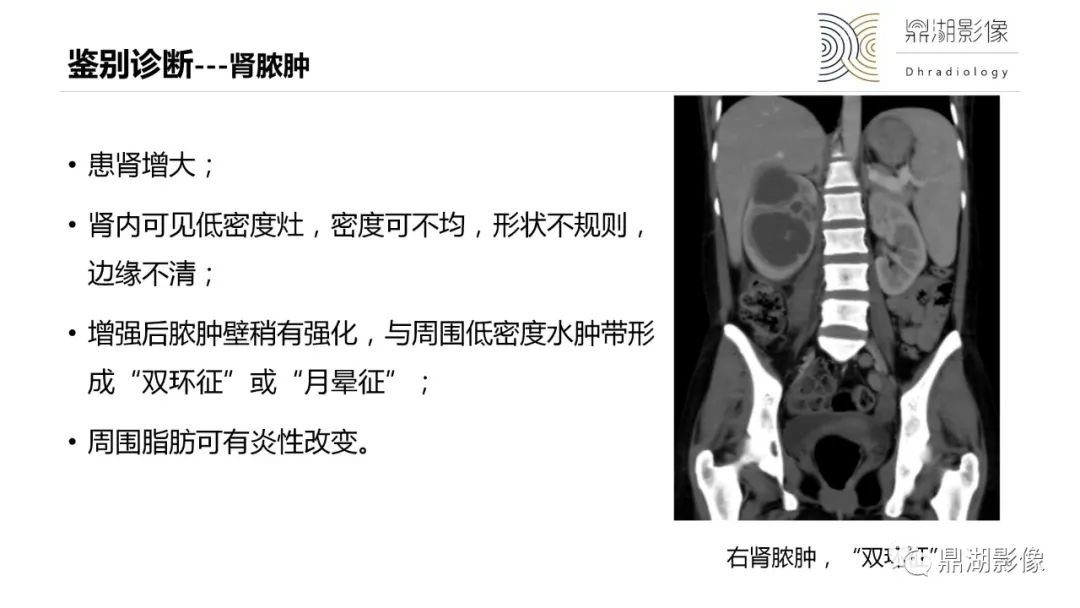 影像PPT - 【PPT】黄色肉芽肿性肾盂肾炎-30 影像PPT - 【PPT】黄色肉芽肿性肾盂肾炎-30