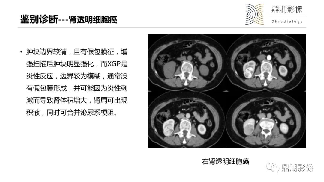 影像PPT - 【PPT】黄色肉芽肿性肾盂肾炎-31 影像PPT - 【PPT】黄色肉芽肿性肾盂肾炎-31
