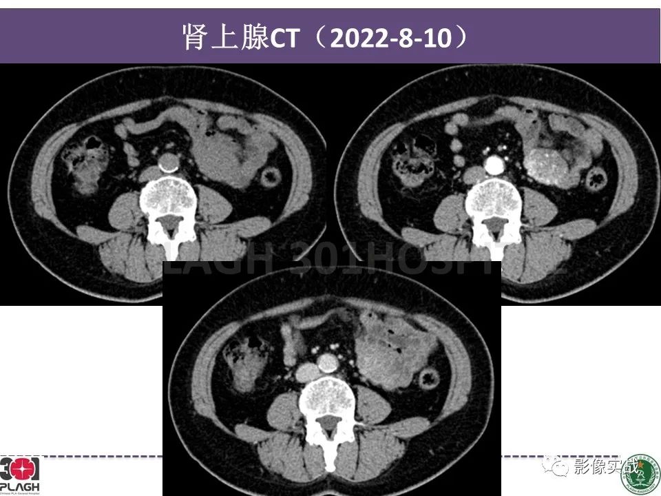 影像PPT - 【病例】小肠间质瘤1例CT影像-4