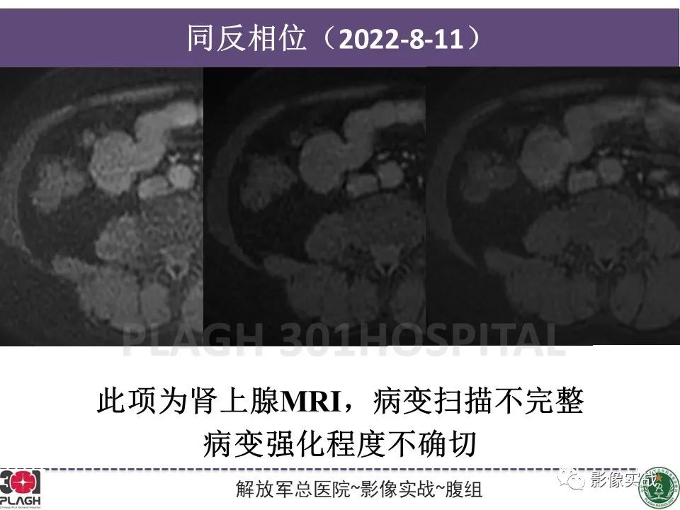 影像PPT - 【病例】小肠间质瘤1例CT影像-7