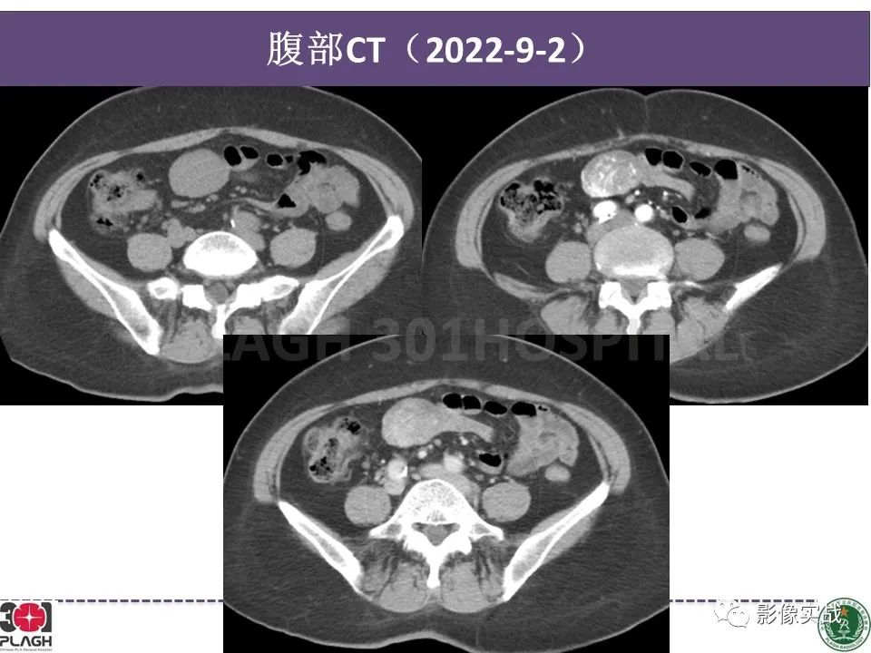 影像PPT - 【病例】小肠间质瘤1例CT影像-8