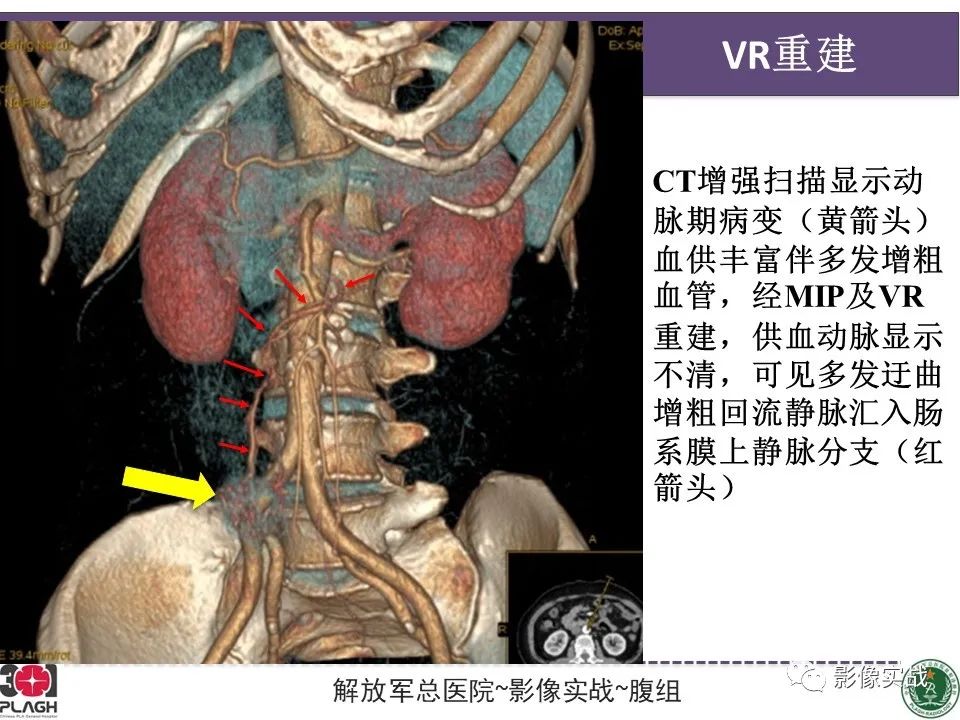 影像PPT - 【病例】小肠间质瘤1例CT影像-9