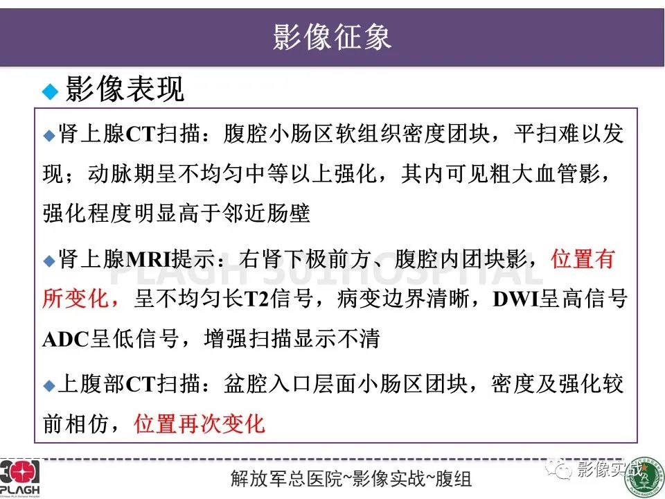 影像PPT - 【病例】小肠间质瘤1例CT影像-11
