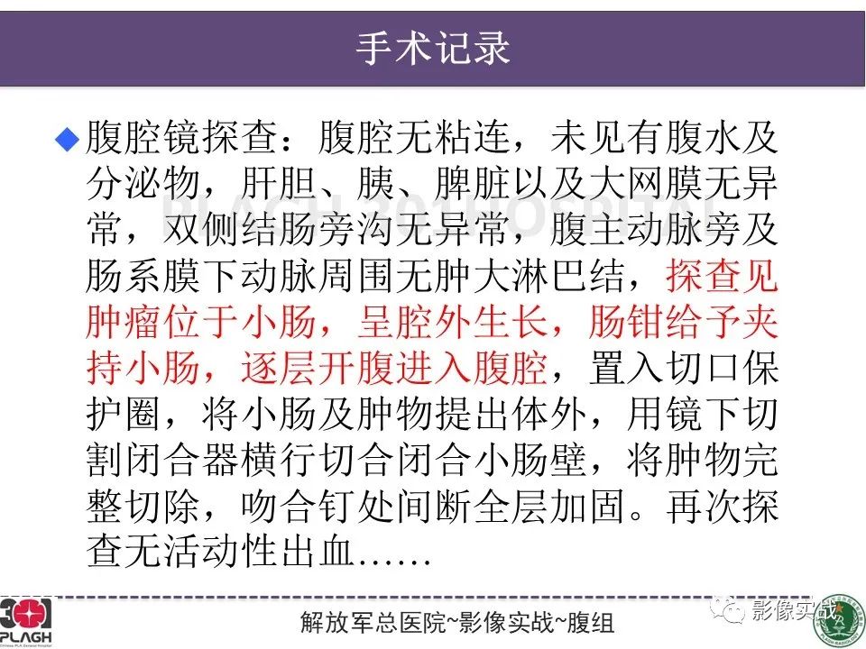 影像PPT - 【病例】小肠间质瘤1例CT影像-17