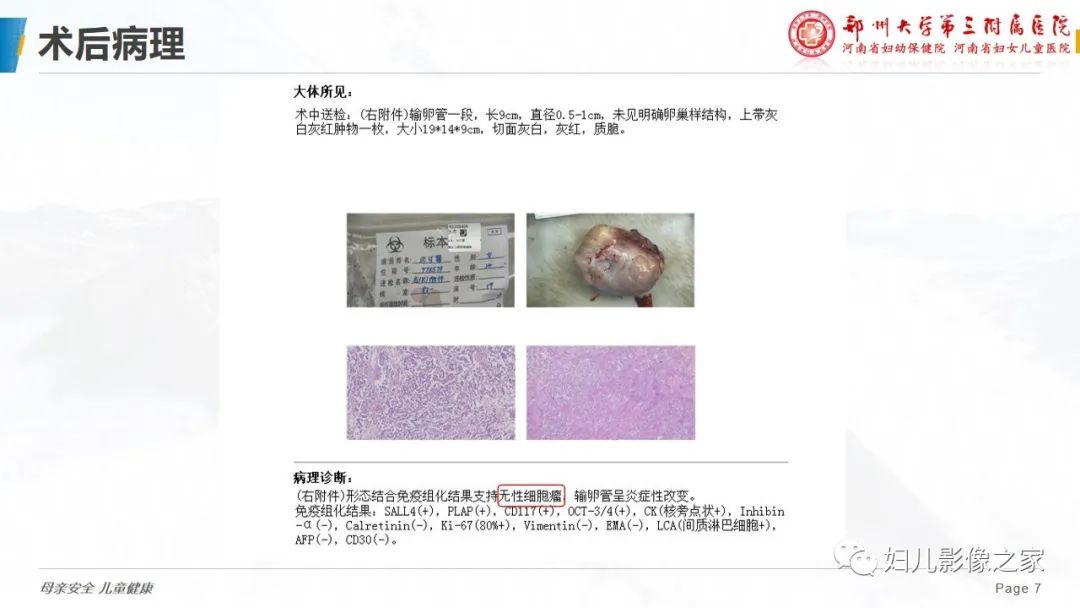 影像PPT - 【病例】卵巢无性细胞瘤1例CT及MR影像-7
