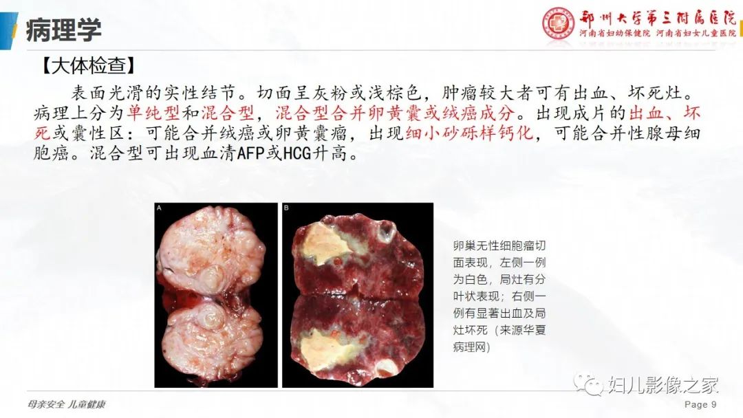 影像PPT - 【病例】卵巢无性细胞瘤1例CT及MR影像-9