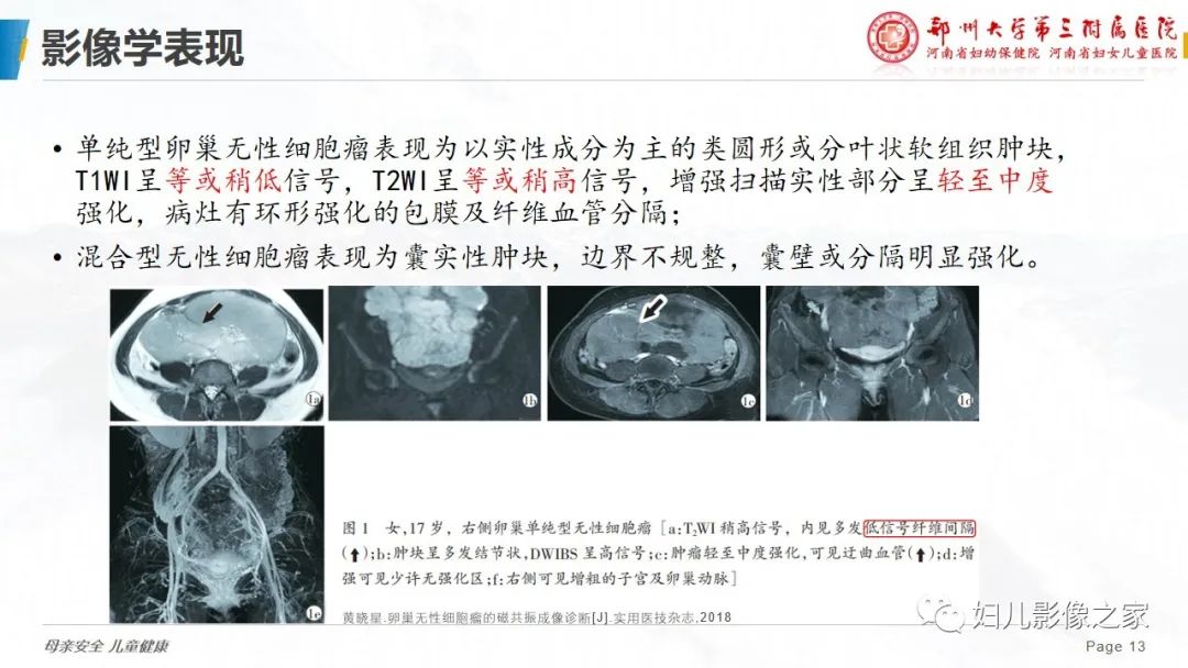 影像PPT - 【病例】卵巢无性细胞瘤1例CT及MR影像-13