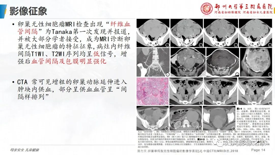 影像PPT - 【病例】卵巢无性细胞瘤1例CT及MR影像-14