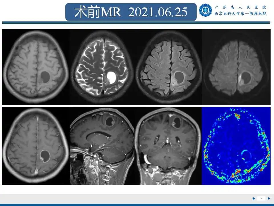 影像PPT - 【PPT】胶质瘤术后复发-3
