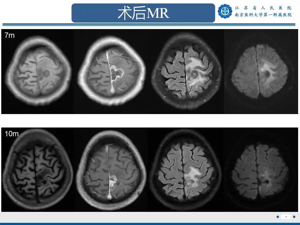 影像PPT - 【PPT】胶质瘤术后复发-5