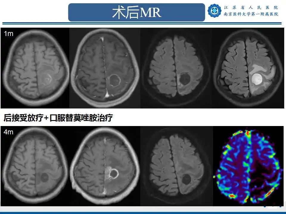 影像PPT - 【PPT】胶质瘤术后复发-4