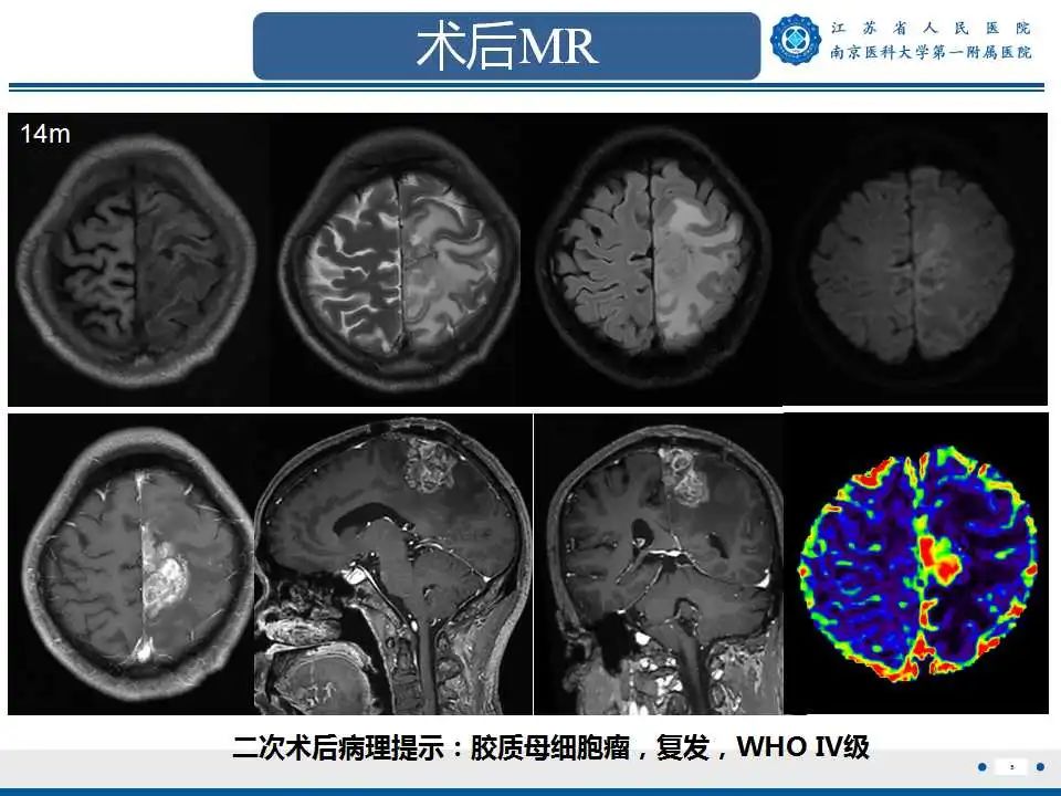 影像PPT - 【PPT】胶质瘤术后复发-6