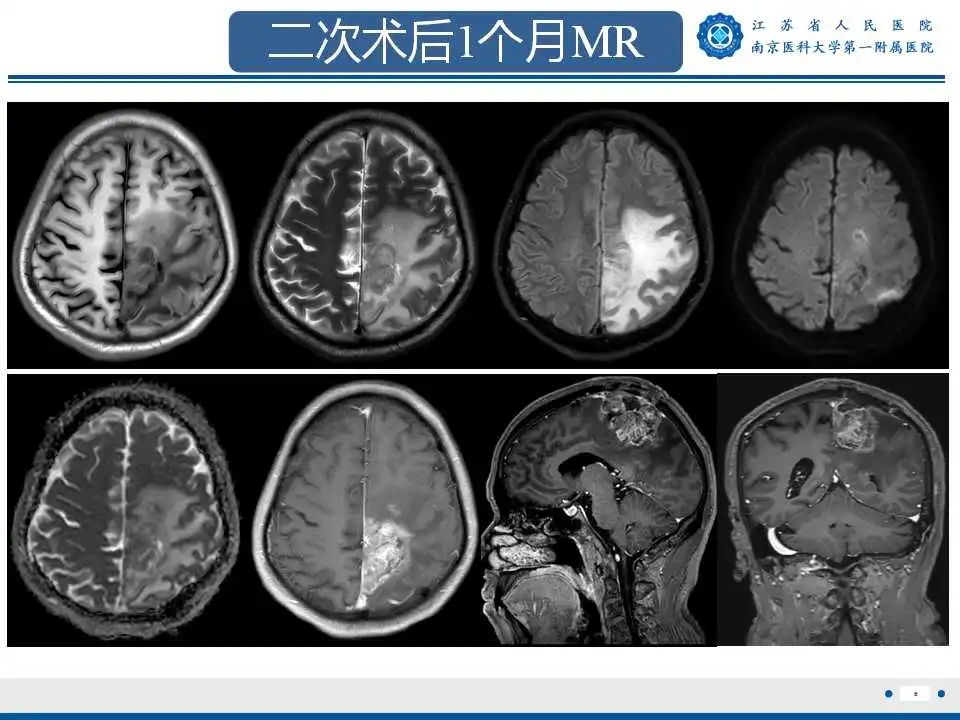 影像PPT - 【PPT】胶质瘤术后复发-7