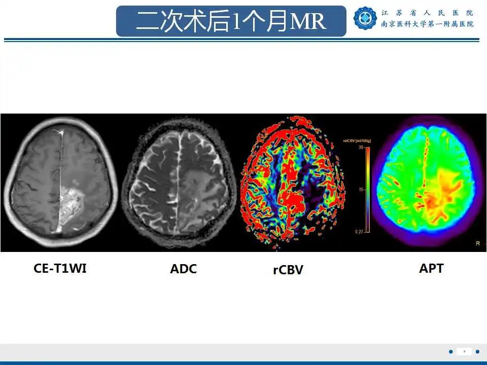 影像PPT - 【PPT】胶质瘤术后复发-8