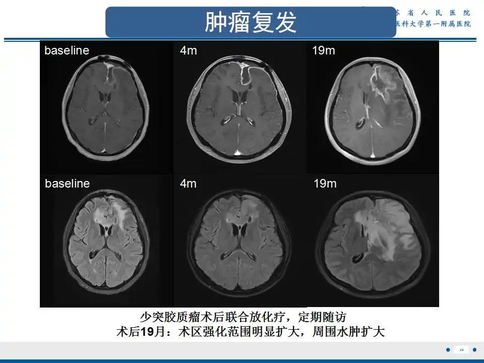影像PPT - 【PPT】胶质瘤术后复发-21
