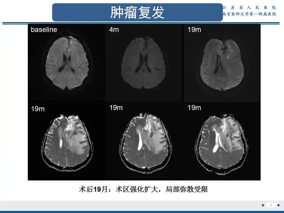 影像PPT - 【PPT】胶质瘤术后复发-22