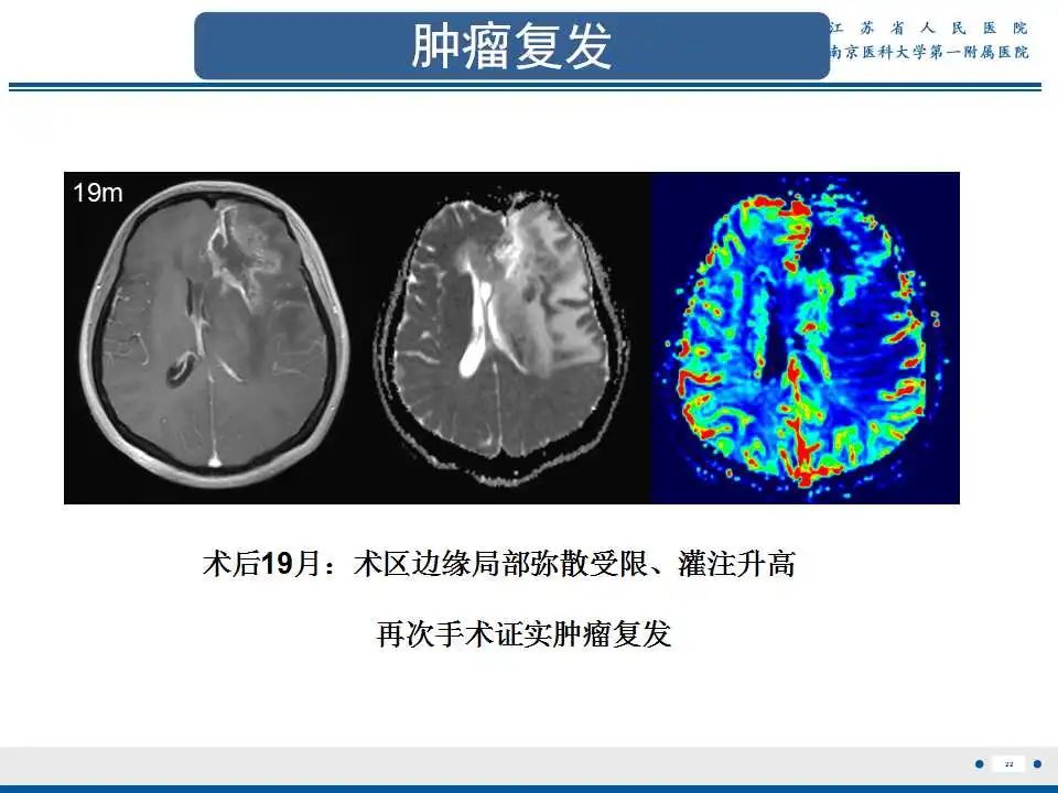 影像PPT - 【PPT】胶质瘤术后复发-23