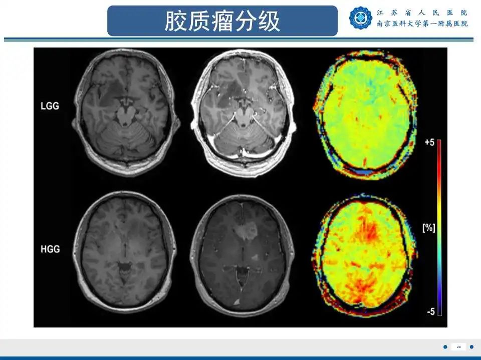影像PPT - 【PPT】胶质瘤术后复发-30