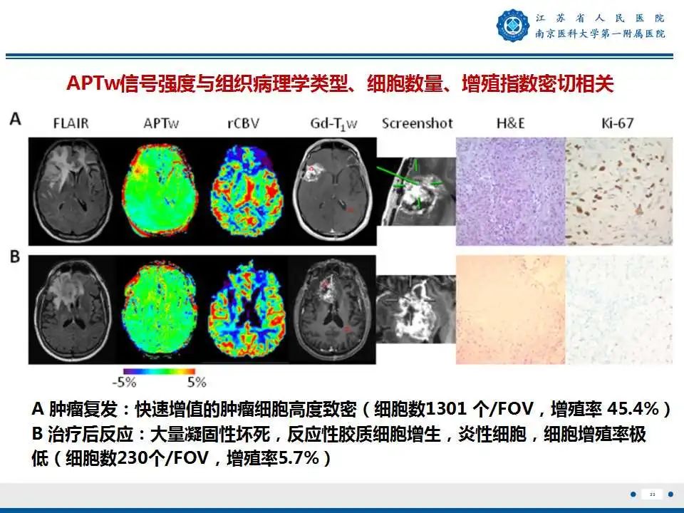 影像PPT - 【PPT】胶质瘤术后复发-34