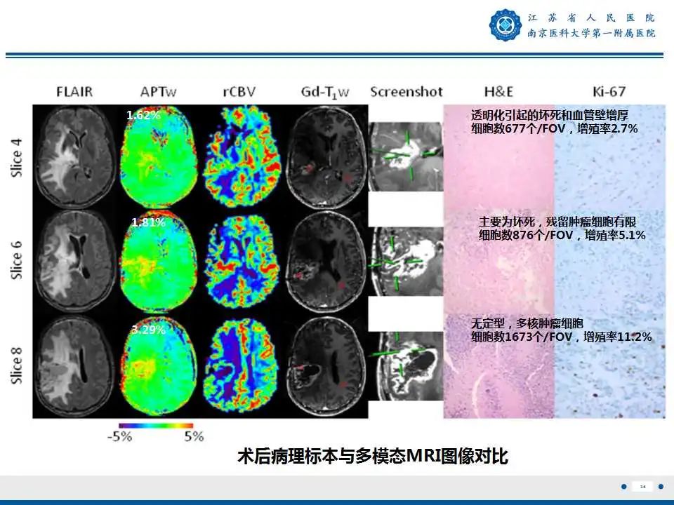 影像PPT - 【PPT】胶质瘤术后复发-35