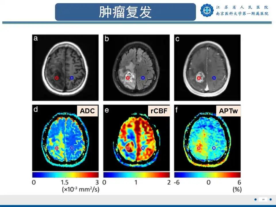 影像PPT - 【PPT】胶质瘤术后复发-36