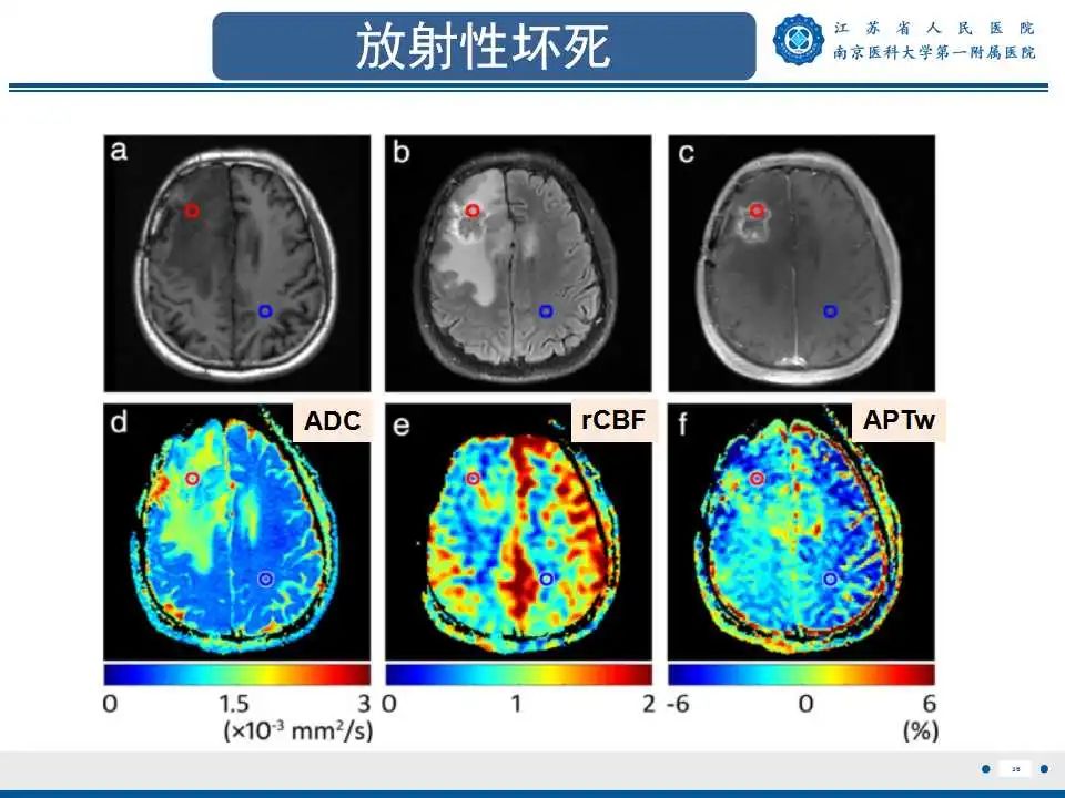 影像PPT - 【PPT】胶质瘤术后复发-37