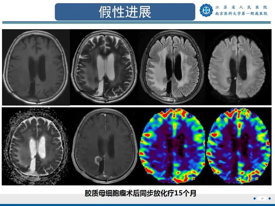 影像PPT - 【PPT】胶质瘤术后复发-38