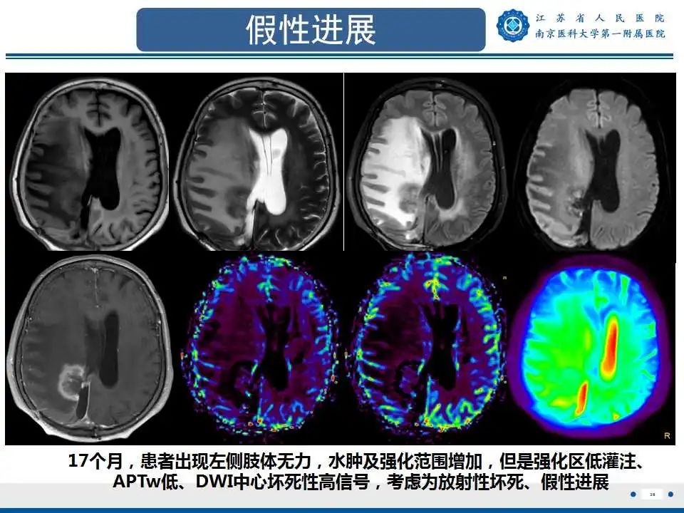 影像PPT - 【PPT】胶质瘤术后复发-39