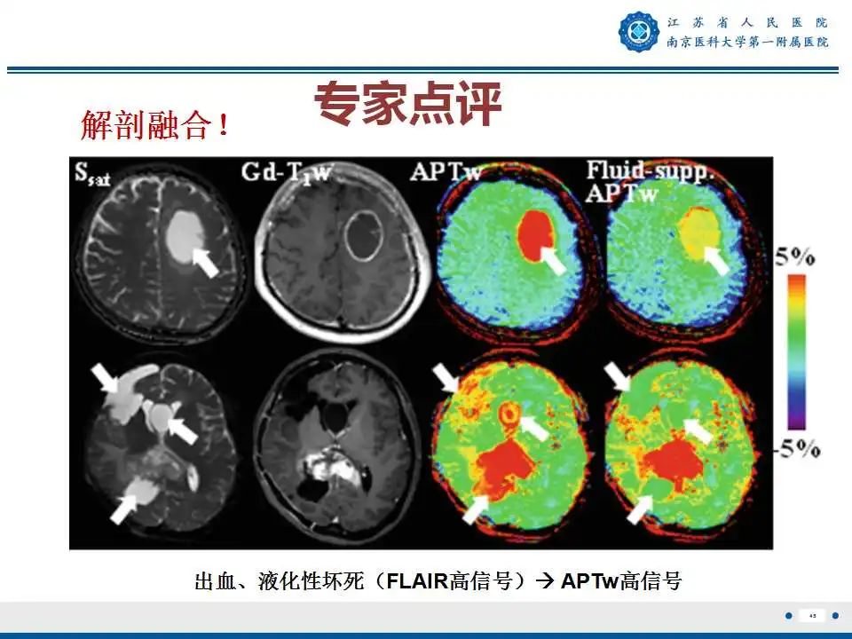 影像PPT - 【PPT】胶质瘤术后复发-46