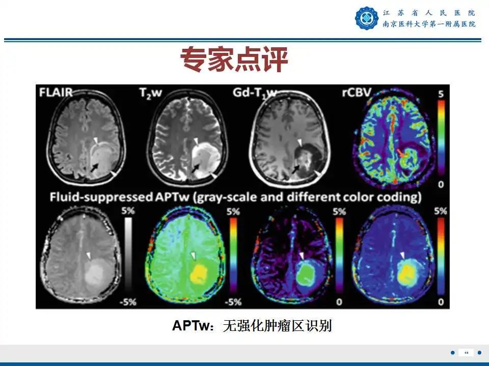 影像PPT - 【PPT】胶质瘤术后复发-47