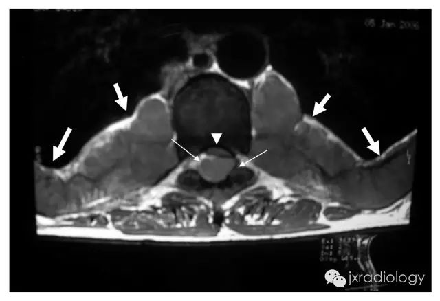 影像PPT - 纵隔糖葫芦征—髓外造血-2 影像PPT - 纵隔糖葫芦征—髓外造血-2