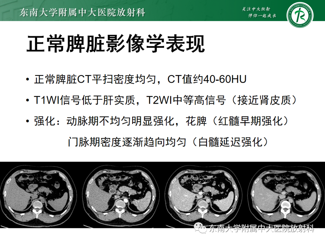 影像PPT - 【PPT】脾脏硬化性血管瘤样结节性转化-5