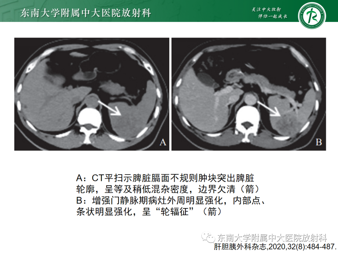 影像PPT - 【PPT】脾脏硬化性血管瘤样结节性转化-9