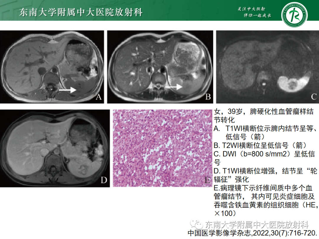 影像PPT - 【PPT】脾脏硬化性血管瘤样结节性转化-10