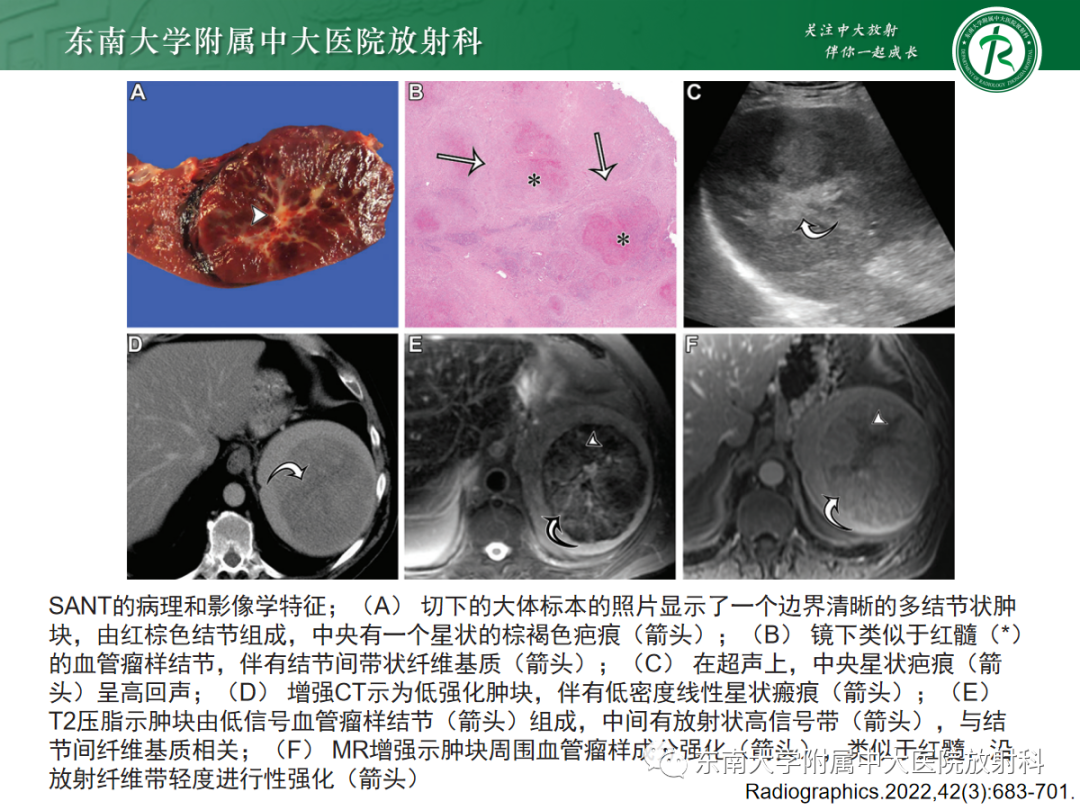 影像PPT - 【PPT】脾脏硬化性血管瘤样结节性转化-11