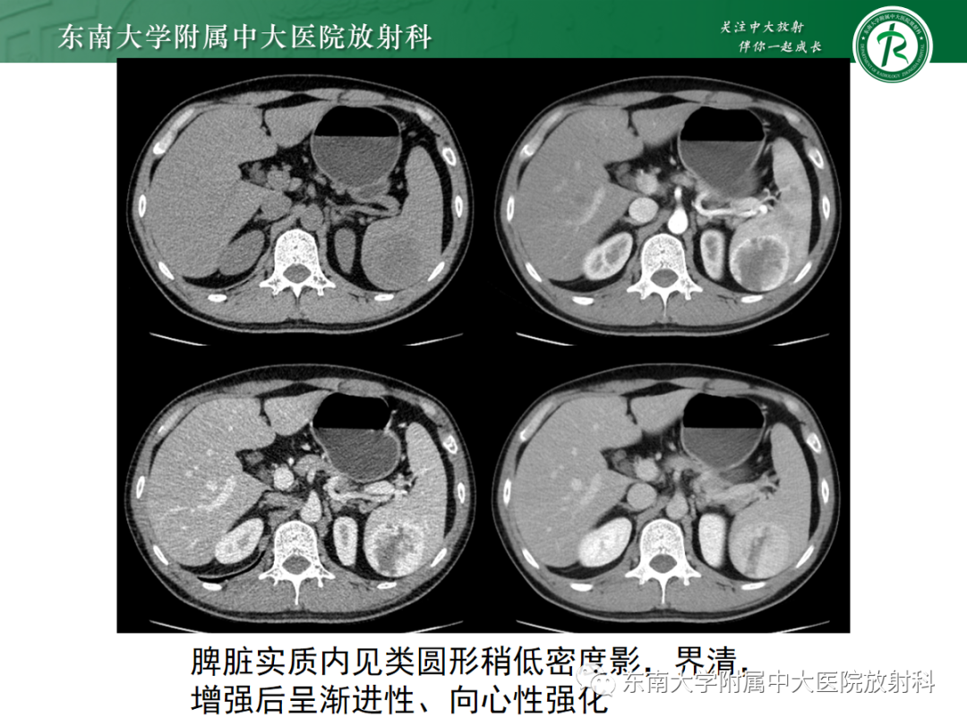 影像PPT - 【PPT】脾脏硬化性血管瘤样结节性转化-15