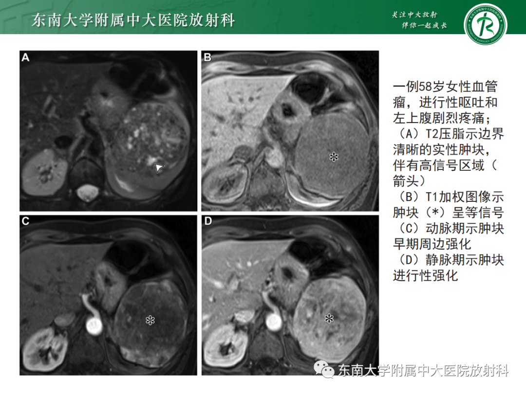 影像PPT - 【PPT】脾脏硬化性血管瘤样结节性转化-16