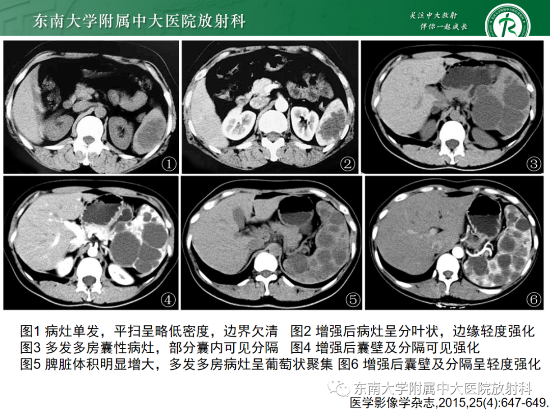 影像PPT - 【PPT】脾脏硬化性血管瘤样结节性转化-18