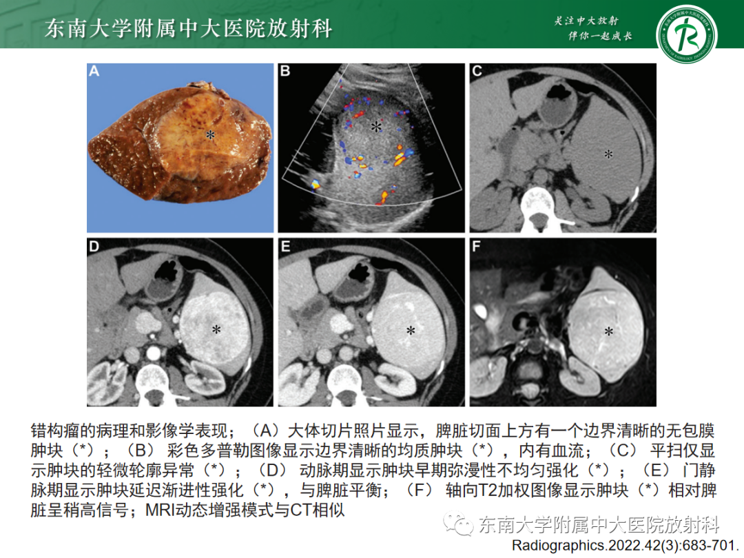 影像PPT - 【PPT】脾脏硬化性血管瘤样结节性转化-20