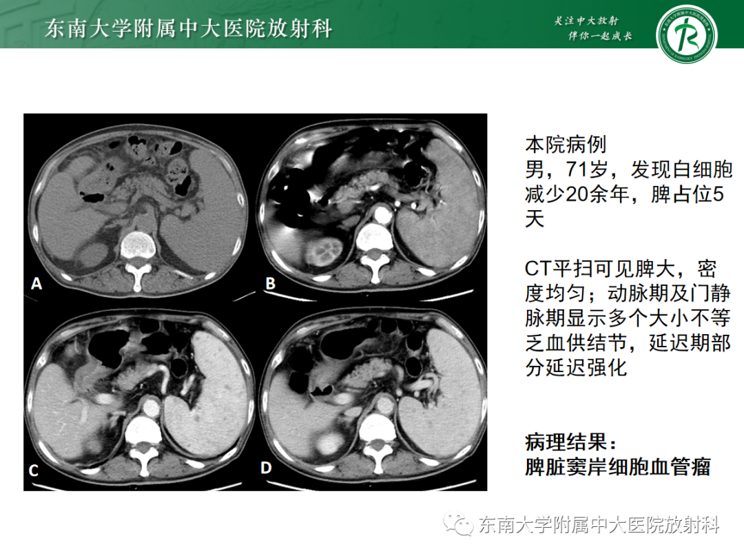 影像PPT - 【PPT】脾脏硬化性血管瘤样结节性转化-23
