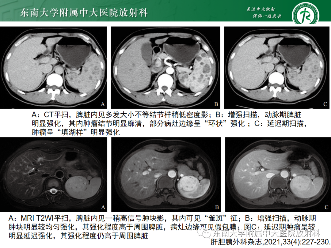 影像PPT - 【PPT】脾脏硬化性血管瘤样结节性转化-24