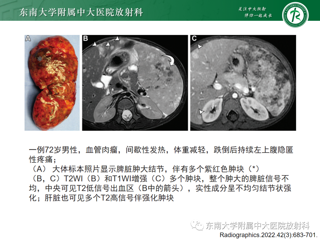 影像PPT - 【PPT】脾脏硬化性血管瘤样结节性转化-27